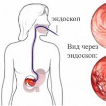 Гастрит желудка: первые симптомы и признаки