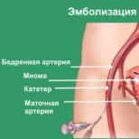 Эмболизация маточных артерий как метод терапии миомы матки