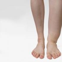 Yaşlılarda bacakların şişmesi: nedenleri, tedavisi, önlenmesi