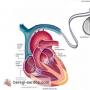 Instalimi i një stimuluesi kardiak: indikacionet dhe kundërindikacionet, operimi dhe ndërlikimet e mundshme, kostoja, etj.