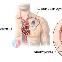 Installazione di un pacemaker cardiaco: intervento chirurgico, controindicazioni