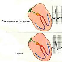 Cardiac tachycardia - what kind of disease is this?
