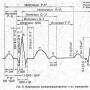 Az EKG dekódolása, normál indikátorok