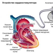 Kardiostimulátor: čo to je, účinnosť, prevádzka inštalácie