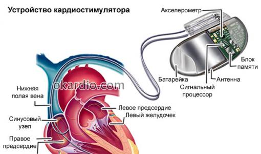 Kardiostimulátor: čo to je, účinnosť, prevádzka inštalácie